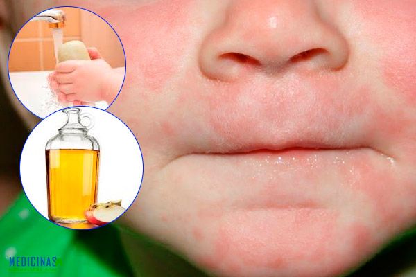 Roseola Sintomas Y Alternativas Naturales