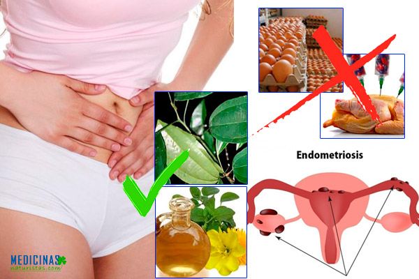 Endometriosis síntomas y tratamientos naturales