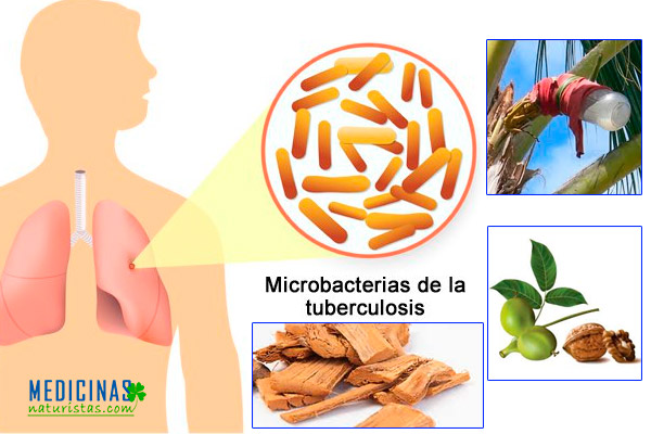 Tuberculosis pulmonar plantas y remedios caseros